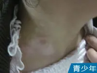 青少年颈部白癜风白斑案例