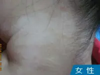 女性颈部白癜风白斑案例