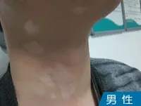 男性颈部白癜风白斑案例
