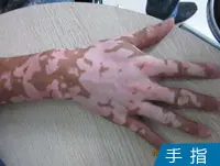手指白癜风白斑案例