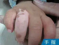 小孩手指白癜风白斑案例
