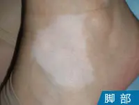 脚背白癜风白斑案例
