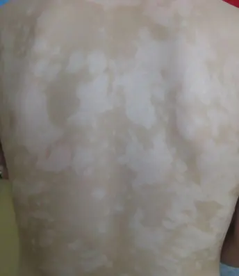 背部白癜风白斑案例