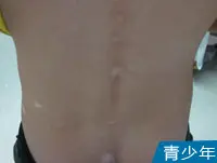 青少年白癜风白斑案例