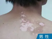男性白癜风白斑案例