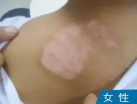 女性白癜风白斑案例