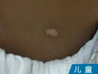 儿童白癜风白斑案例