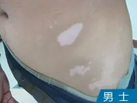 男士白癜风白斑案例